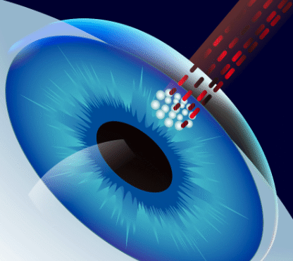 YAG Laser Treatment